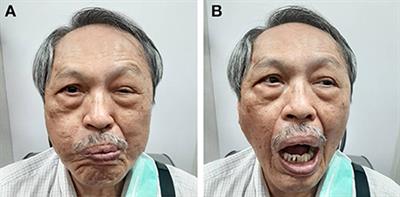 Case report: Early onset Marin-Amat syndrome after receiving ChAdOx1 nCoV-19 vaccination